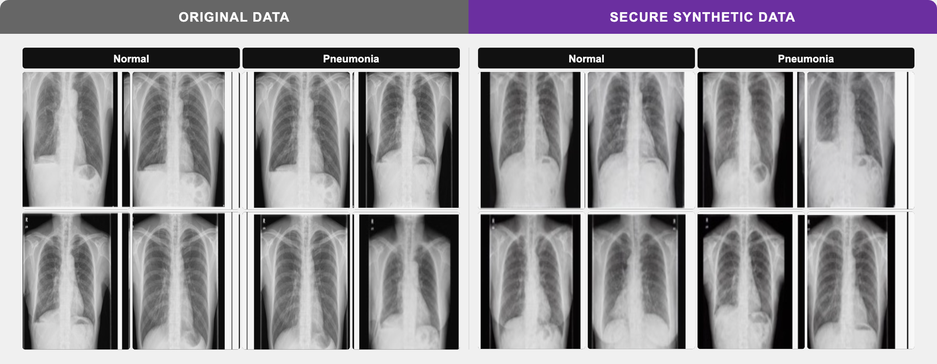 폐렴 X-ray — 원본 vs 합성